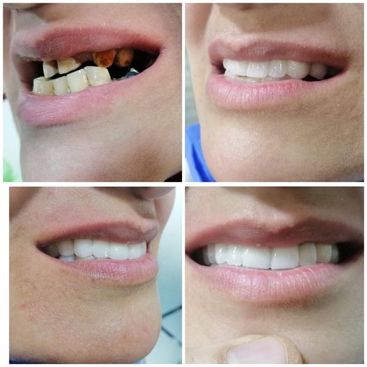 Teeth beautification and occlusion adjustment using dental cosmetic formulations In Jordan