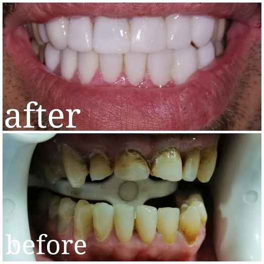 Dental implant surgery In Jordan