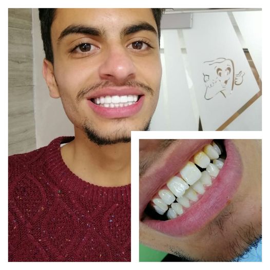 In one session, a veneer was performed (Hollywood smile) inside the Facing Clinic In Jordan