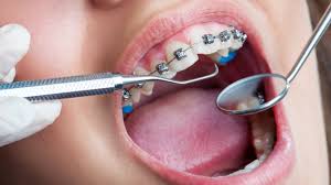 Orthodontics in jordan 